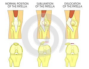 Knee joint problem_Dislocation of the patella