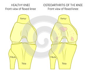 Knee joint problem_osteoarthritis