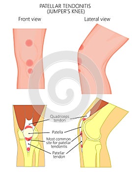 Knee joint problem_Patellar tendonitis or jumper knee. Front and lateral views