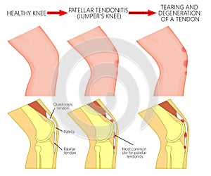 Knee joint problem_Patellar tendonitis or jumper knee. Progress