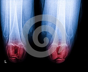 Knee joint x-ray (AP and LATERAL) view fracture and displacement of the patella bone or knee cap, highlighted in red