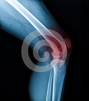 Knee joint x-ray (AP and LATERAL) view fracture and displacement of the patella bone or knee cap, highlighted in red