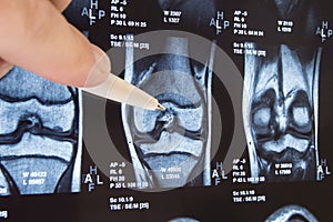 Knee joint x-ray or MRI. Doctor pointed on area of knee joint, where pathology or problem is detected, such fracture, destruction