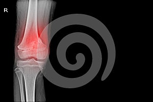 Knee joint x-ray  showing  fracture distal femur on red mark.and black background