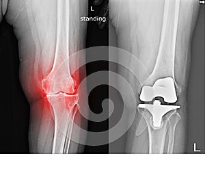 Knee joint x-ray showing osteoarthritis and bone regeneration, with total Knee Replacement