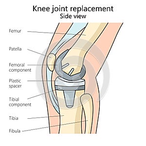 knee joint replacement structure medical science