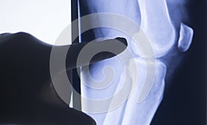 Knee joint xray test scan