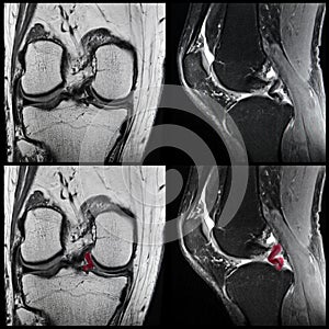 Knee ligament tear, MRI