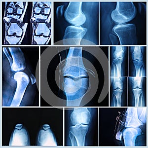 Knee medical exam: X-ray and MRI scan