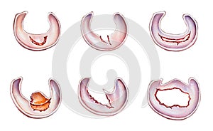 Knee - Meniscus Tears photo