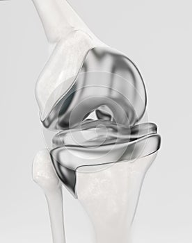 Knee with modern knee prosthesis - 3D Rendering