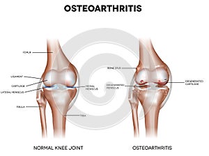 Knee Osteoarthritis