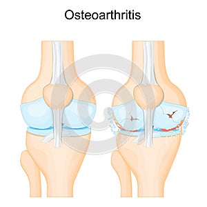 Knee osteoarthritis. degenerative joint disease photo