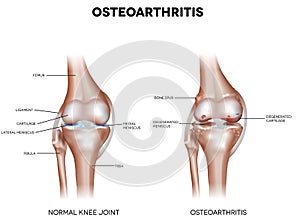 Knee Osteoarthritis photo