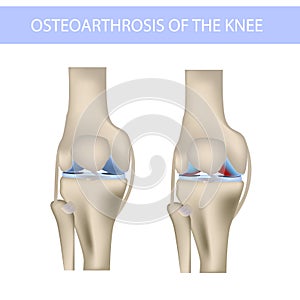 Knee osteoarthritis, realistic medical vector illustration