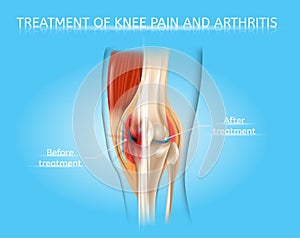 Knee Pain and Arthritis Treatment Vector Chart