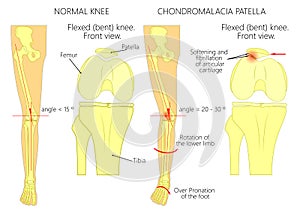 Knee Pain and chondromalacia patella