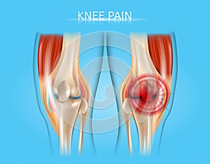 Knee Pain Realistic Vector Anatomical Illustration