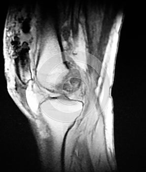 Knee postoperative changes effusion synovial debris photo