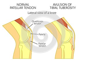 Knee problem_Avulsion of tibial tuberosity