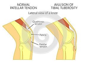 Knee problem_Avulsion of tibial tuberosity photo