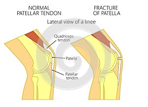 Knee problem_Fracture of patella