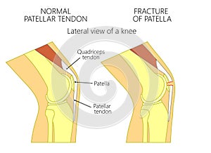 Knee problem_Fracture of patella photo