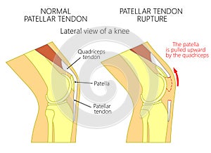 Knee problem_Patellar tendon rupture photo