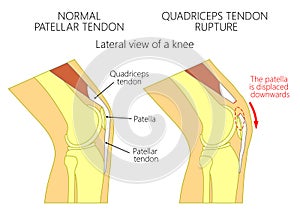 Knee problem_Quadriceps tendon rupture