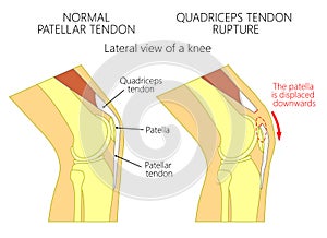 Knee problem_Quadriceps tendon rupture photo