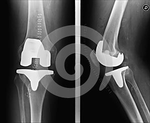 Knee with prosthesis