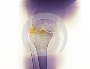 Knee x-ray showing arthritis