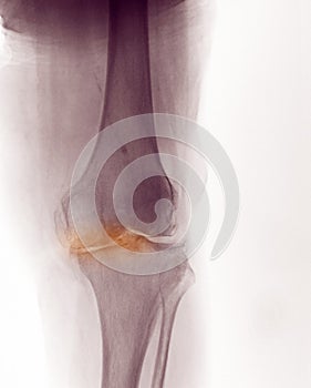 Knee x-ray showing arthritis