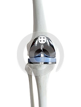 A knee replacement