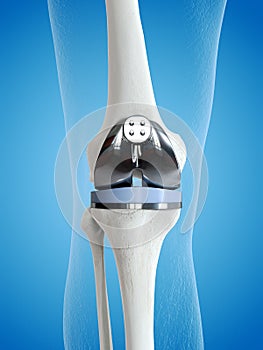 A knee replacement