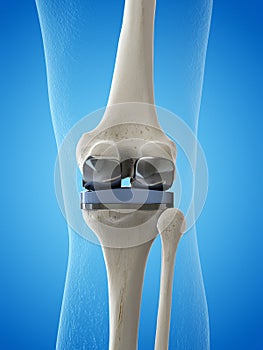 a knee replacement