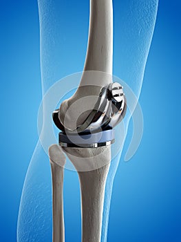 a knee replacement