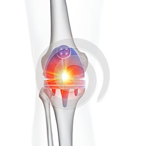 A knee replacement