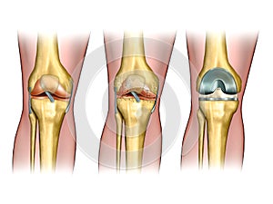 Rodilla intercambio 