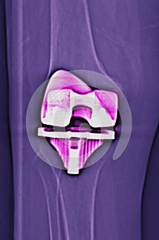 Knee replacement (knee arthroplasty)