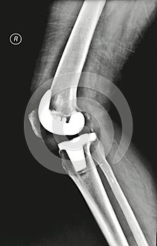 Knee replacement X-ray pictures
