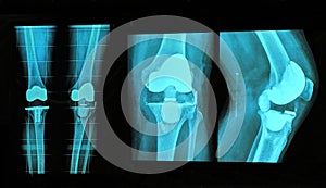 knee replacement xray