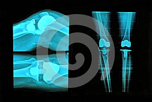 knee replacement xray