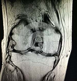 Knee rheumatoid arthritis severe synovitis mri