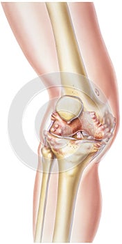 Knee - Rheumatoid Arthritis photo