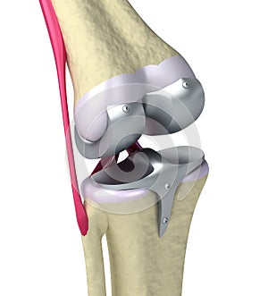 Knee and titanium hinge joint