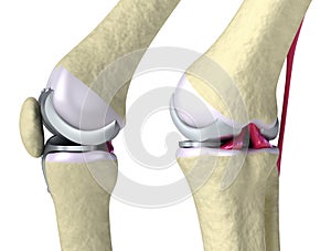 Knee and titanium hinge joint