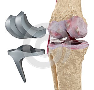 Knee and titanium hinge joint. Isolated photo