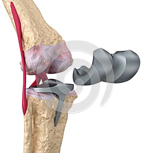Knee and titanium hinge joint. Isolated