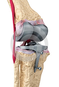 Knee and titanium hinge joint. Isolated photo